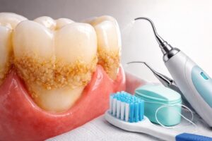 découvrez comment se forme le tartre des dents, ses causes principales et les solutions efficaces pour l'éviter et le traiter afin de préserver votre santé bucco-dentaire.