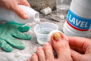 découvrez les erreurs courantes à éviter pour un traitement efficace à la javel contre la mycose de l'ongle du pied et protégez votre santé podologique.