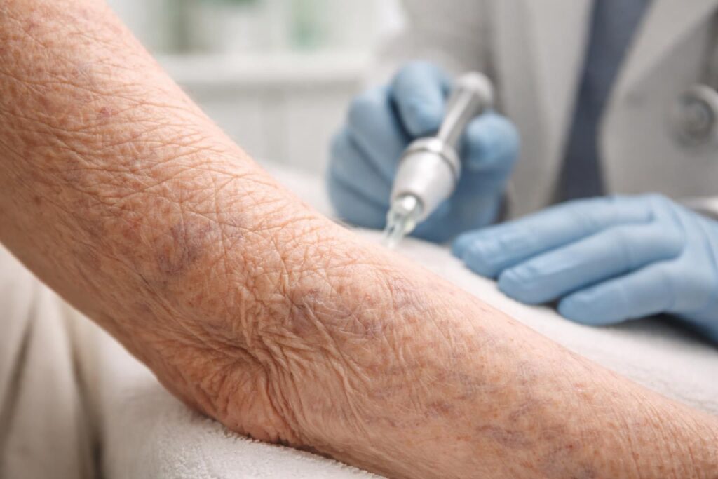 découvrez tout ce que vous devez savoir sur la dermatoporose, ses symptômes visibles en photo et les traitements efficaces pour améliorer l'apparence et la santé de votre peau.